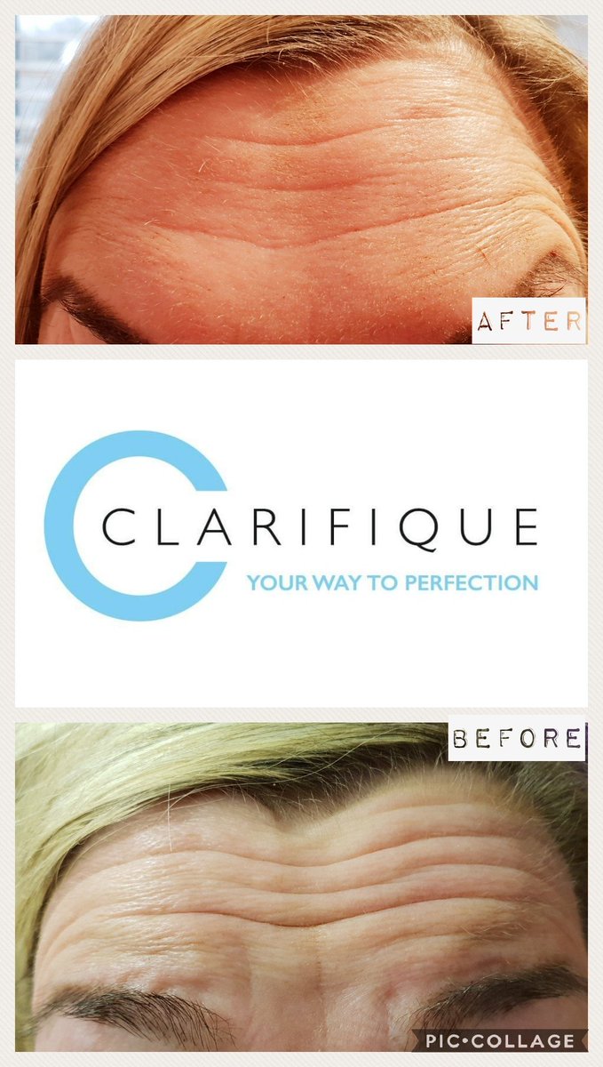 Clarifique1's tweet photo. Went to see this lovely lady for her two week review after she had three areas of Anti-Wrinkle Injections. She was that happy with results, even got a hug! 😁 contact us if you would like to book in for a free consultation 😊
#azzalure #aesthetic #beauty https://t.co/tvH82n3cnq
