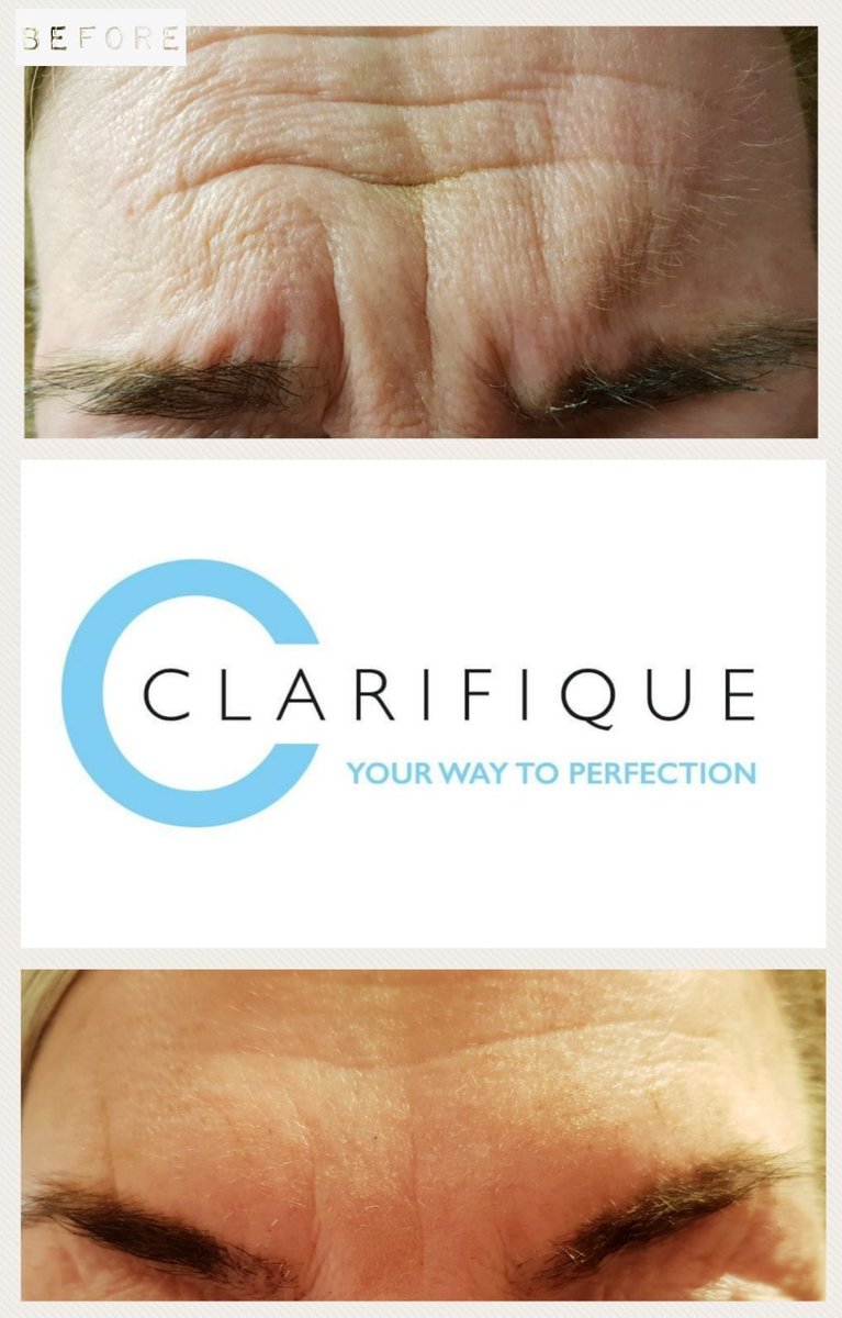 Clarifique1's tweet photo. Went to see this lovely lady for her two week review after she had three areas of Anti-Wrinkle Injections. She was that happy with results, even got a hug! 😁 contact us if you would like to book in for a free consultation 😊
#azzalure #aesthetic #beauty https://t.co/tvH82n3cnq