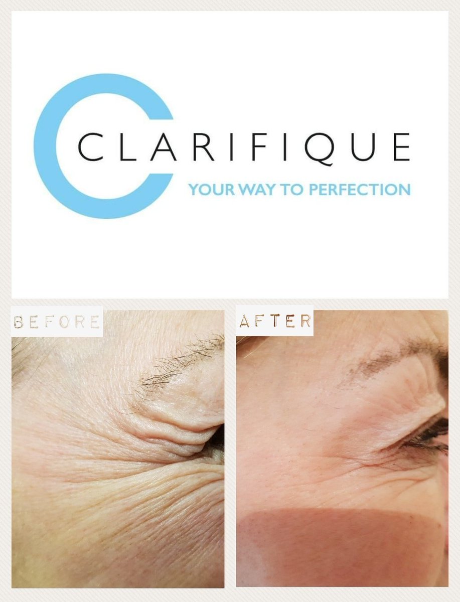 Clarifique1's tweet photo. Went to see this lovely lady for her two week review after she had three areas of Anti-Wrinkle Injections. She was that happy with results, even got a hug! 😁 contact us if you would like to book in for a free consultation 😊
#azzalure #aesthetic #beauty https://t.co/tvH82n3cnq