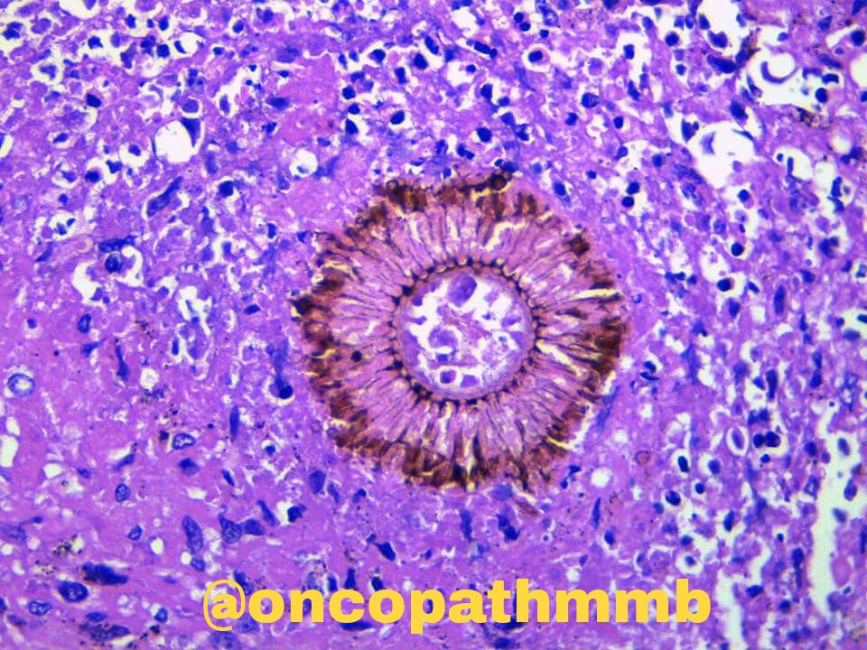Case of chronic necrotizing aspergillosis- A.niger #pathology #pulmpath #lungpath