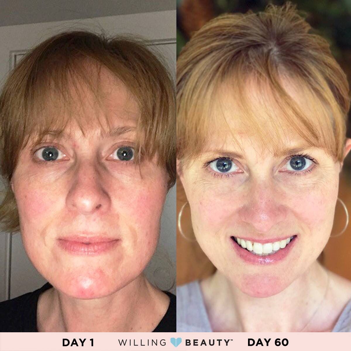 InspiredBeauty6's tweet photo. Look at these Amazing resultsππ€. Who wants beautiful skin using a SAFE product? You can benefit in the same way. π Msg Meπ Iβm here to help you reach your skincare goals. π #beautifulskin #hy5skincareregimen #stayconsistent #girlboss #womensupportingwomen #youwillgetresults https://t.co/tQ6Y13EPYj
