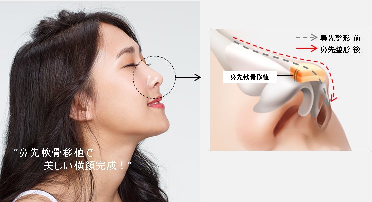 韓国gng病院 美容外科 鼻先が低くてお悩みの方は 自家軟骨を使用して綺麗なラインに改善してあげましょう 軟骨挿入位置 軟骨の採取部位はこちらです 韓国 韓国整形 Gng Gng病院 韓国美容外科 鼻先 自家軟骨 低い鼻 丸い鼻 韓国