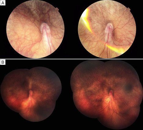 OphthaTweets's tweet photo. Congenital muscular dystrophy-dystroglycanopathy, type A, featuring bilateral retinal dysplasia and vertical angle kappa via #JAAPOS https://t.co/RXK3iQm6ZR https://t.co/BJMQEbYydB