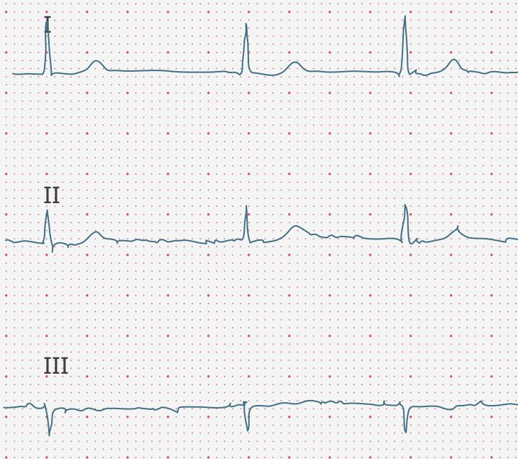 ecgbuddy's tweet photo. Happy Monday everyone! What’s this patient’s heart axis?

#ECG #ecgbuddy #studybuddy #doctopia #ecg #ecginterpretation #ecgreading #ecgcourse #emergencyroom #hospitallife #medicalstudent #medschool #medicallife #ERlife #doctorslife https://t.co/wM6df6VLvv