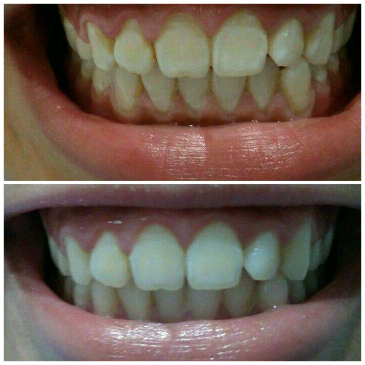 TTWCCork's tweet photo. Results at #theteethwhiteningcliniccork. #Byebye #stainedteeth in one hour.
#whiterteethcork #corkbusiness #beforeafter https://t.co/KhUxlg6Xcd