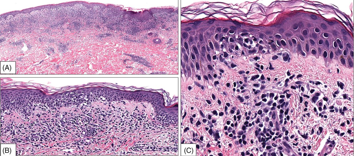 American Society of Dermatopathology (@asdptweets) on Twitter photo MT <a href="/RosNazarianMD/">Rosalynn Nazarian MD</a> Epidermotropic splenic B-cell #lymphoma a rare mimicker of the more common cutaneous T-cell lymphoma. Beware of aberrant CD20+ expression in mycosis fungoides! Clonal IgH peak and splenomegaly seen here. #dermpath #pathology MT <a href="/RosNazarianMD/">Rosalynn Nazarian MD</a> Epidermotropic splenic B-cell #lymphoma a rare mimicker of the more common cutaneous T-cell lymphoma. Beware of aberrant CD20+ expression in mycosis fungoides! Clonal IgH peak and splenomegaly seen here. #dermpath #pathology