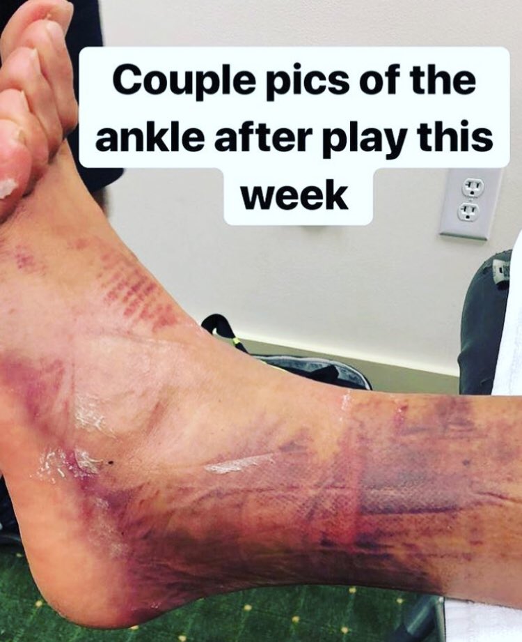 Tony Finau’s ankle 😱