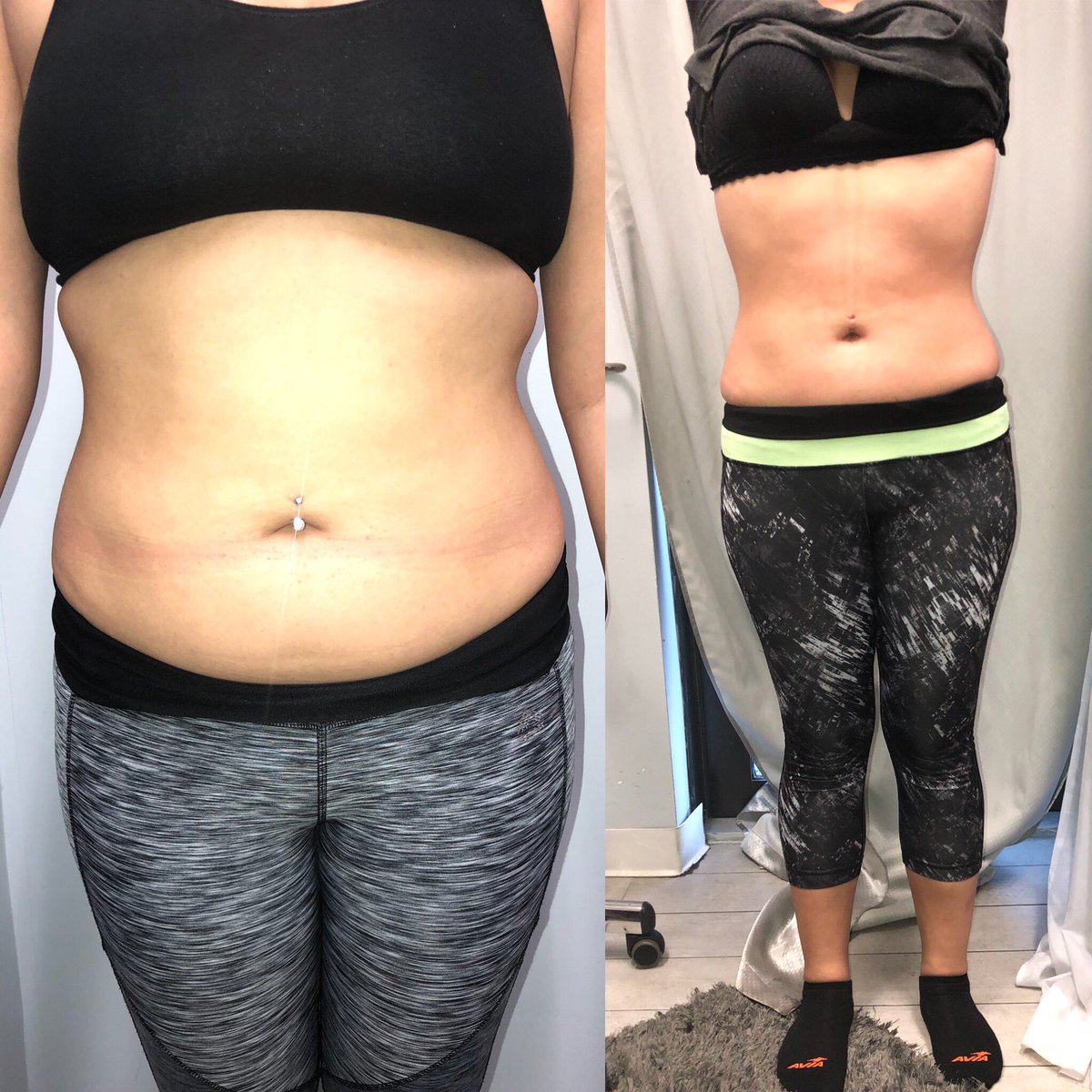 EliteBodyServi1's tweet photo. Before &amp; After pics of our happy client 5 Sessions! Schedule today 305-814-5036 https://t.co/WyXeIXbLId