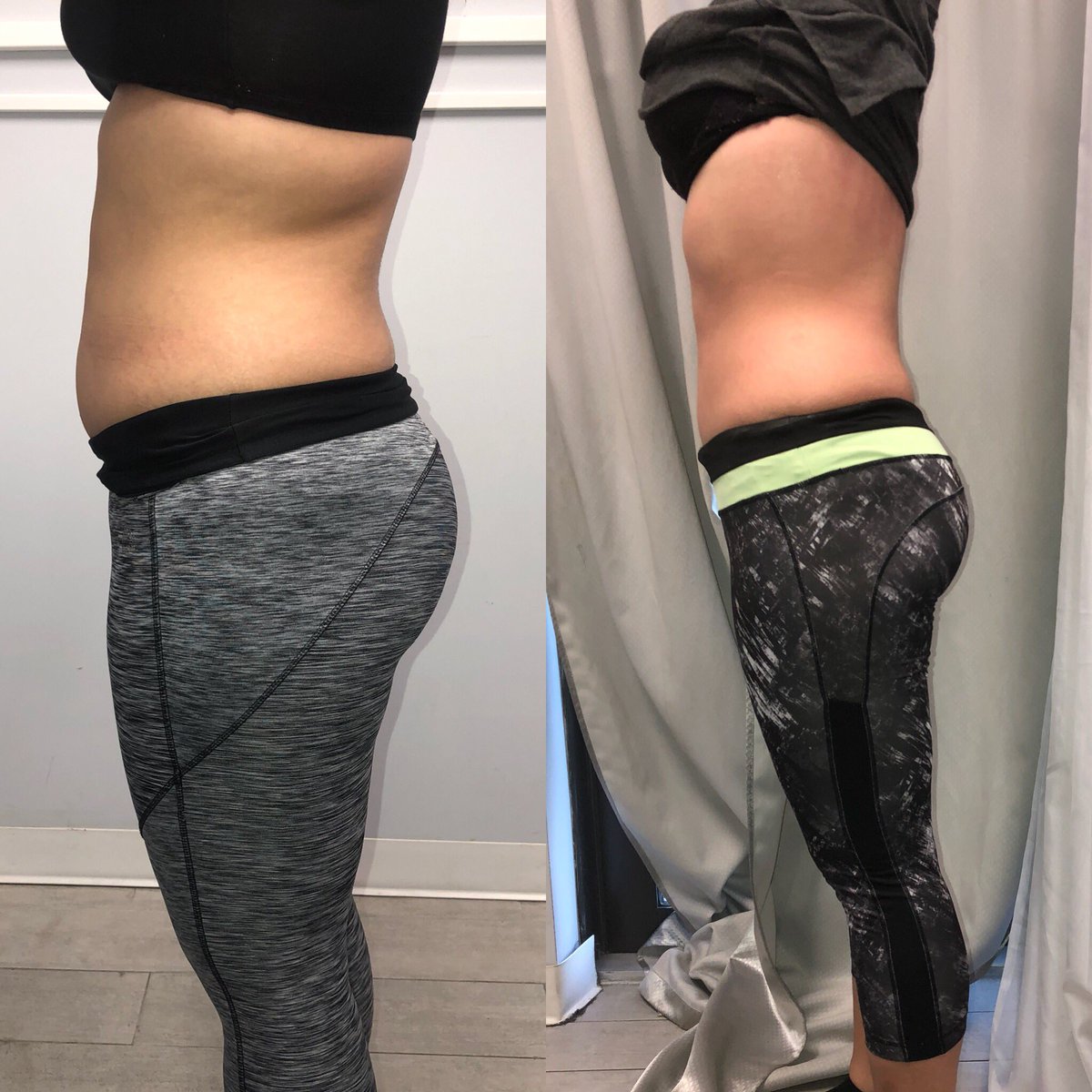EliteBodyServi1's tweet photo. Before &amp; After pics of our happy client 5 Sessions! Schedule today 305-814-5036 https://t.co/WyXeIXbLId
