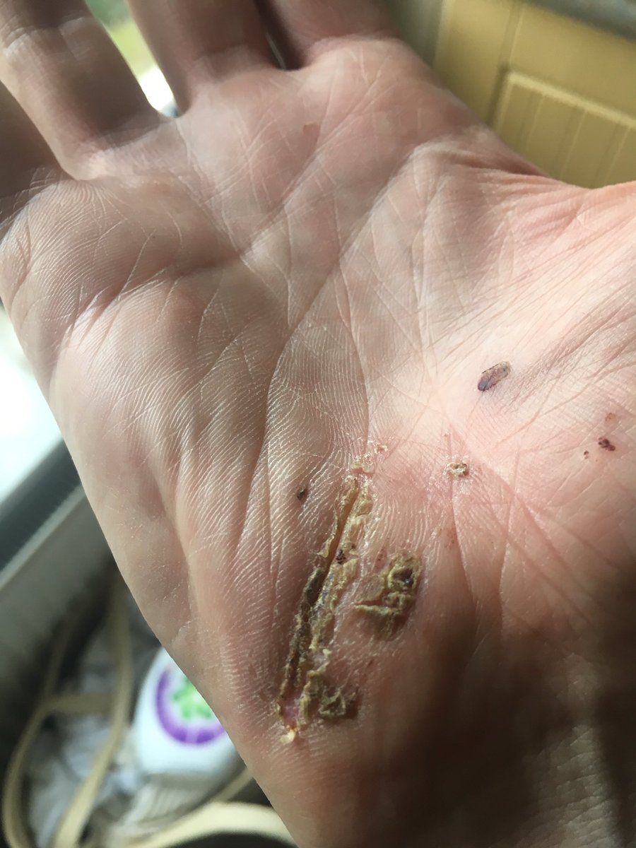 dcrills's tweet photo. Wound #Wound https://t.co/LJ9GuhtlB3