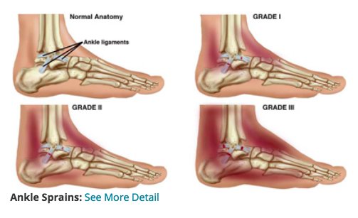 WallaceNilanPT's tweet photo. #TheMoreYouKnow: What is an #AnkleSprain? #APTA #WNPT

https://t.co/vViJermERs https://t.co/FPQVOAD2GZ