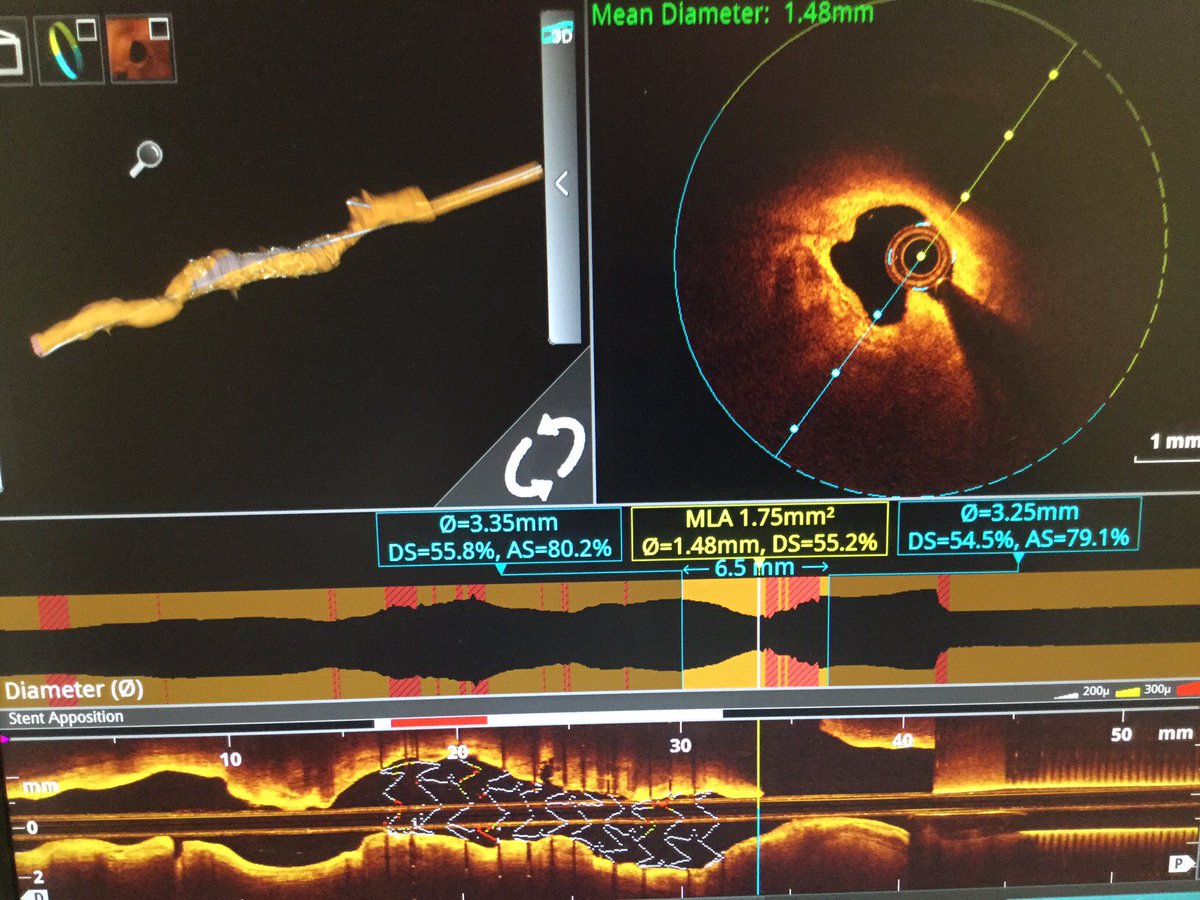 PrecisionPCI's tweet image. #PCIOptimization software with OCT highlights malapposed stent struts in sagittal view, plus it’s a consistent controlled pullback you can measure. And it also highlights ostial LAD stenosis that overlapped LCX on angio 😯
