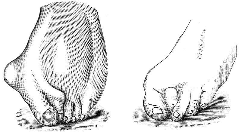 WhoresofYore's tweet photo. Illustration of women’s feet deformed by high heeled, narrow shoes. 

(“Popular Science Monthly”, Volume 24, 1883) https://t.co/PwvgXxp8Yc