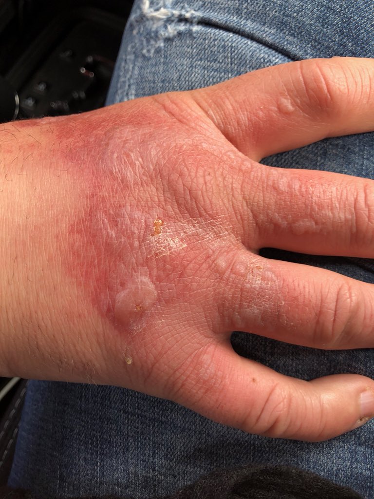 TugCowart's tweet photo. @BJosephRadio @AtlantaSportsX Ok, but get ready to vomit #Phytophotodermatitis #AvoidLimeJuiceAndSunshine #ChemicalReaction @HMason14 https://t.co/4yq5huqglo