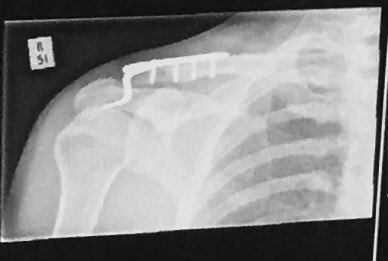 peccadilloman's tweet photo. Iโve lived with this fella for 8 weeks. Iโve become quite attached. But within 8 weeks heโll be leaving me again. #hookplate #clavicle #fb https://t.co/VwQ74726z9