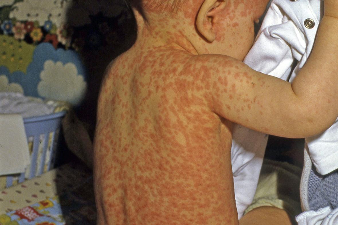 CT24zive's tweet photo. Rodiče věří mýtům o očkování, roste výskyt spalniček. V Praze už je epidemie
https://t.co/9k967ZfYur https://t.co/E9W87IxCTW