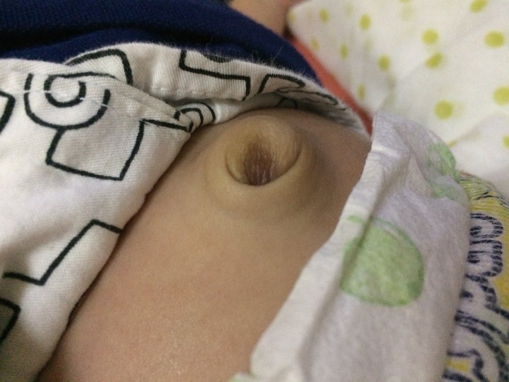 fatinesheh's tweet photo. @DrIqbalSarwar salam doc. Umbilical hernia merbahaya ke? Baby berak dan kentut seperti biasa. Keliling pusat lembut. https://t.co/ujmYo2YRd5