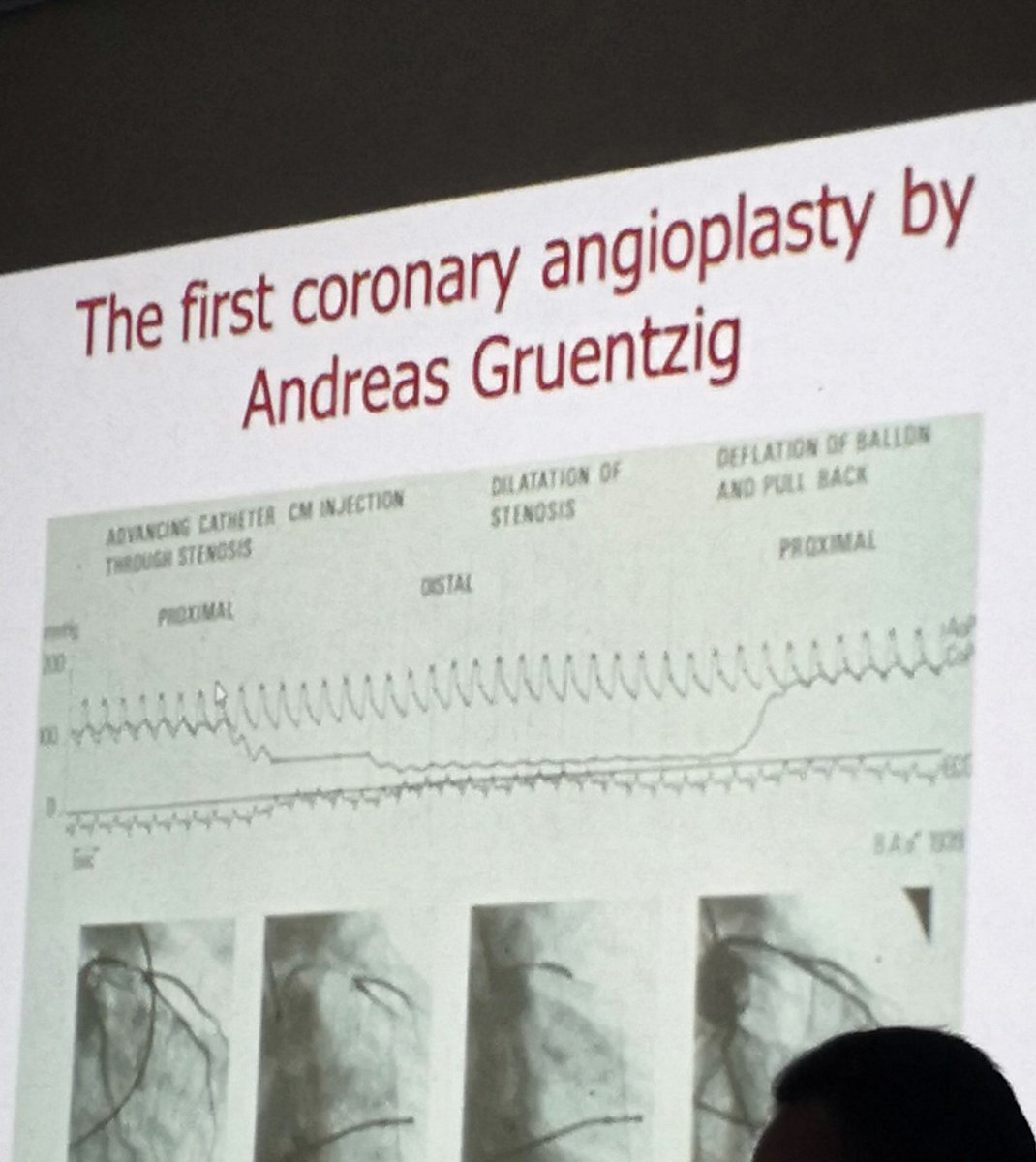cardiorob's tweet photo. @IR_Doctor @angioplastyorg @cardiojaydoc02 @BSCCardiology @cardiojournal @Heart_BMJ @MGHHeartHealth @ajgunnmd @SDhandMD @SIRspecialists @SIRRFS Dr #Gruentzig was ahead of his time.. He was using something like #FFR in 1979.. #Genius https://t.co/MR9MaWOOK3 https://t.co/xhMPlBZzdr