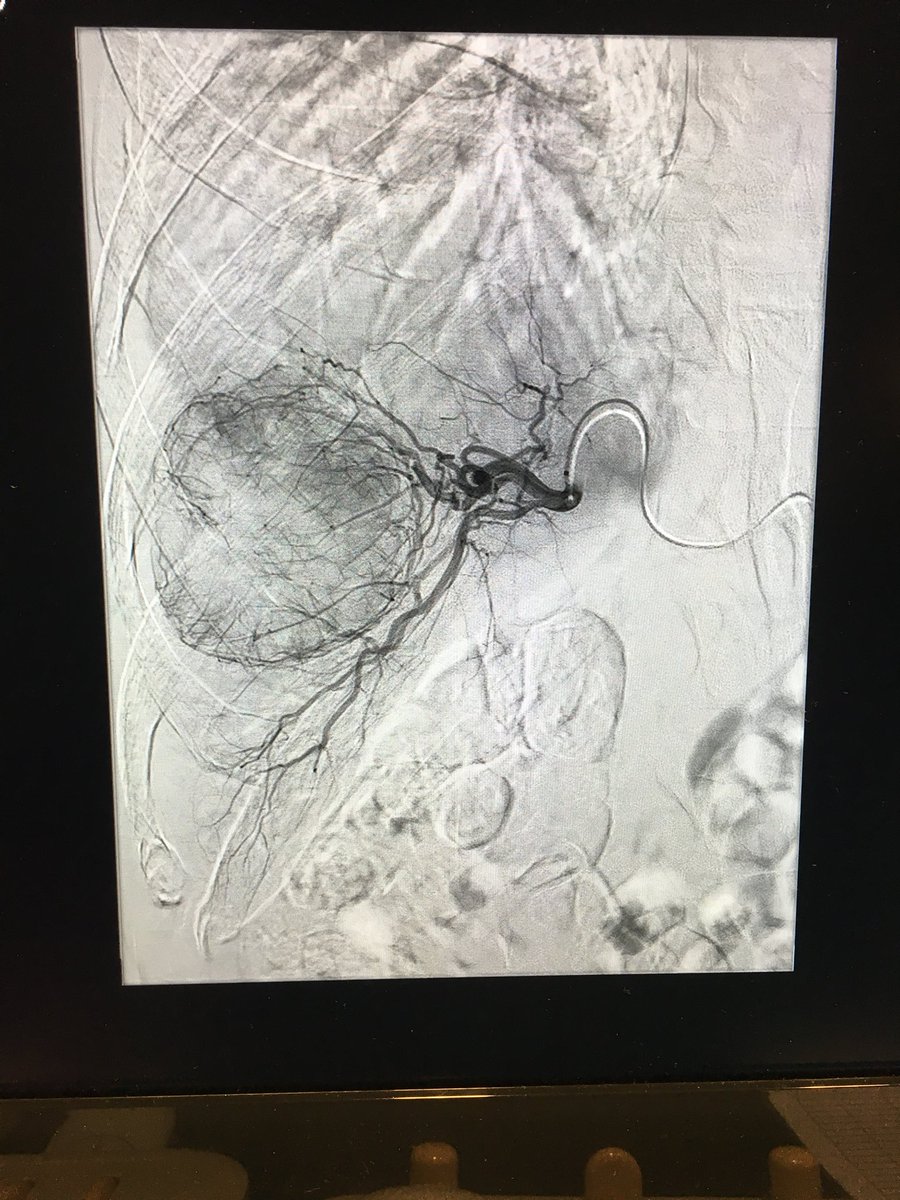 Killing cancer with just a pinhole in the wrist #RadialFirst #segmentectomy #IRad <a href="/SIRRFS/">SIR RFS</a> <a href="/SIRspecialists/">Society of Interventional Radiology</a> @UHSurgery