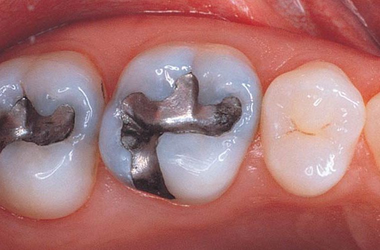MercuryFreeBaby's tweet photo. Momentum builds to end the largest mercury use in U.S.A. - dental amalgam.

https://t.co/myNDUmjJzT https://t.co/qu75Odz6Ll
