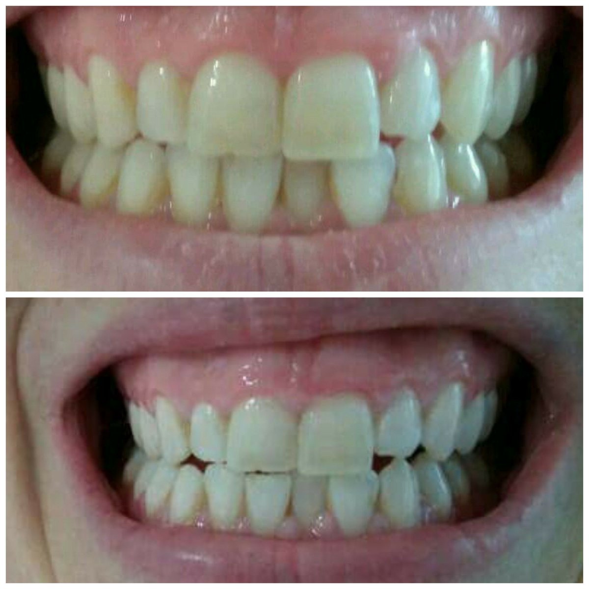 TTWCCork's tweet photo. In just #onehour the difference is easy to see. #beautifulsmiles with #whiterteeth leaving the #TeethWhiteningClinic today. On average 10-12shades. #teethwhiteningcork https://t.co/Rax8SaBl6o