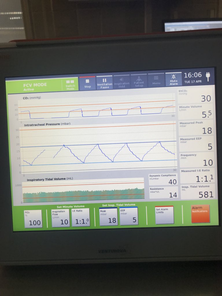 dr_imranahmad's tweet photo. @VentinovaMed @dot_medical great day with the famous Dr Enk who visited us at Guy’s today! We did the first ever Awake bronchoscopic guided tritube Intubation in a patient with critical aireay stenosis!! Love the EVONE #gamechanger https://t.co/kakRqDSDyL