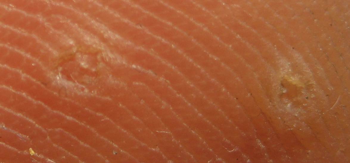 Quelle est votre attitude thérapeutique devant ces verrues plantaires?
Que dites-vous à ce patient?
Réponse ici : dermatoclic.com/verrues
#dermatoclic #DocTocToc #dermatologie #Medecine