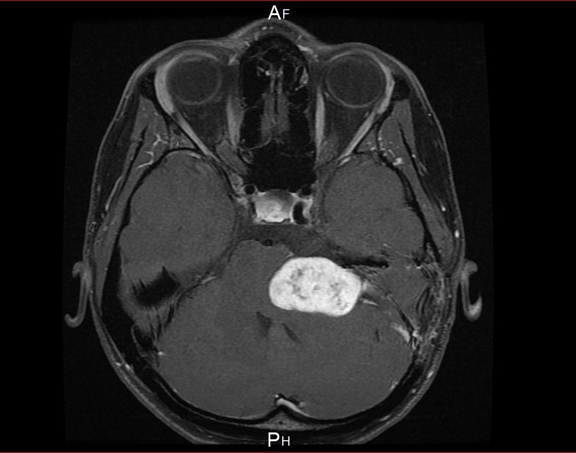 J_Sass's tweet photo. Every brain tumour is different, every patient is different & every journey is different yet we are all fighting for the same thing. To be healthy, happy and free of this terrible disease.
#BrainTumour #TuesdayThoughts #TheBrainTumourCharity #BrainScan #Data #FirstScan https://t.co/V9IVO2eytl