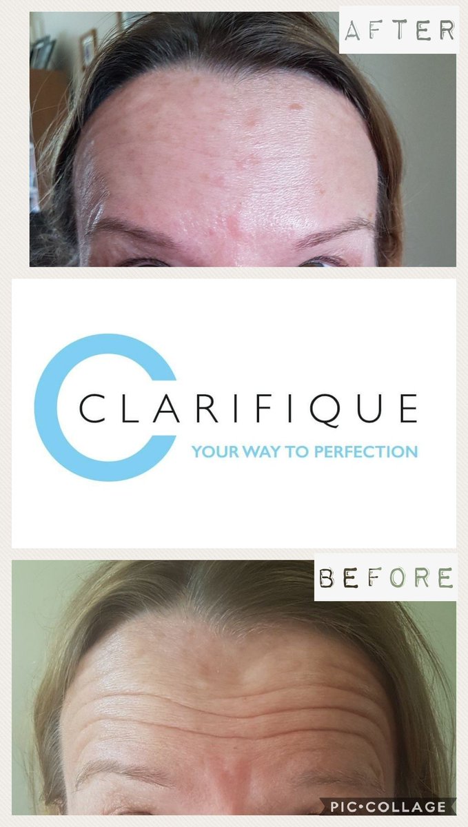 Clarifique1's tweet photo. Two week reviews are all part of the service, went to see this lady this morning. She wanted two areas of anti-wrinkle treatments and happy with the results 😁
Message for your free consultation.
#azzalure #aesthetic #nurse #nurepractioner #twoweekreview #beauty https://t.co/sIzzrIbuaE