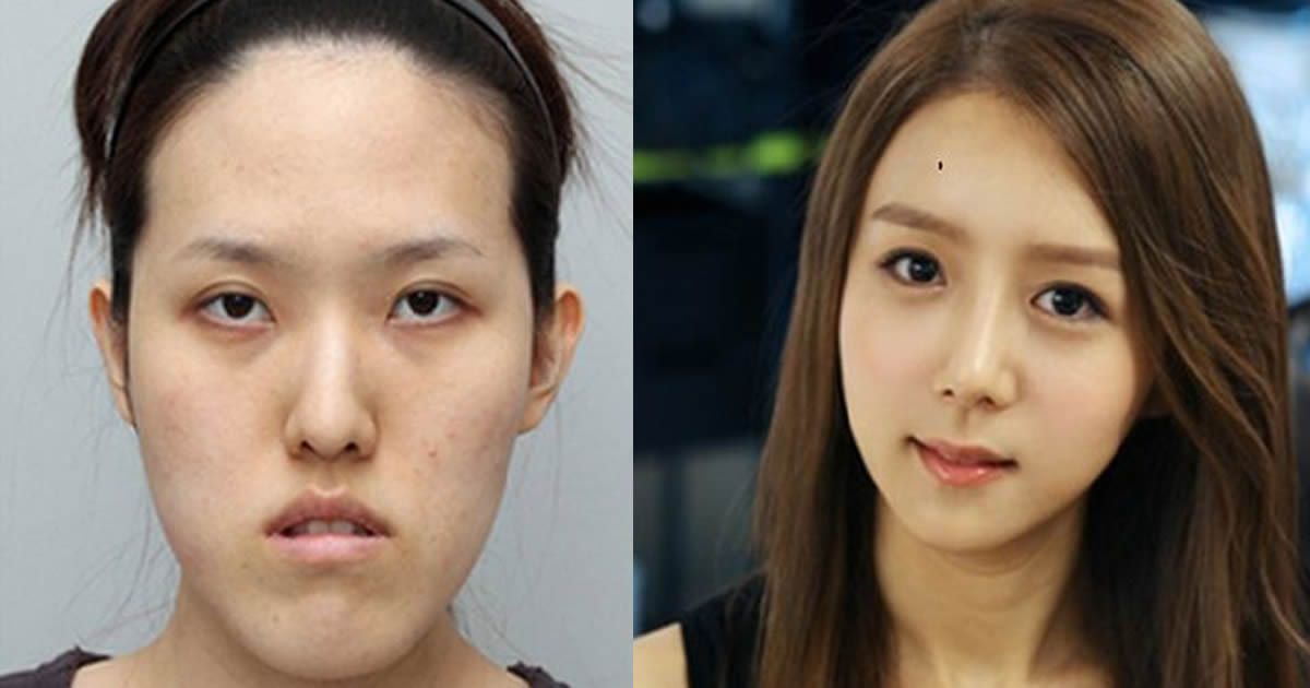 90. 19 Before And After Photos From Korean Plastic Surgery Makeover Show. 