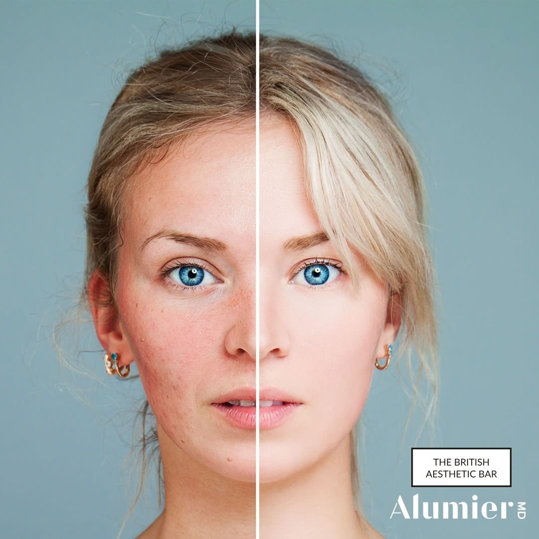 The_BAB_London's tweet photo. Women are three times more likely to suffer from rosacea than men. Our AlumierMD range offers skin care solutions to hydrate and soothe sensitive #Skin prone to #rosacea symptoms such as #redness, including the #CalmR serum and #RecoveryBalm.
#skincare #luxurymedical #rosacea https://t.co/i6nYHfA587