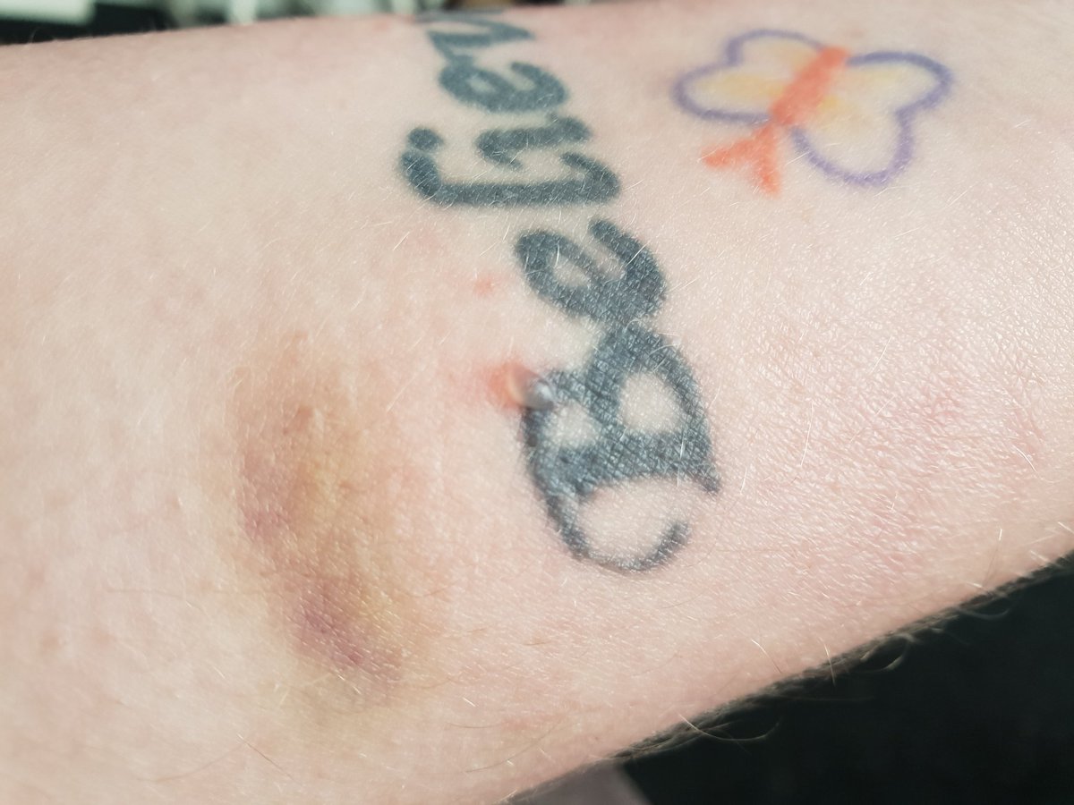 Lilac_Spirals's tweet image. My #FitBitCharge2 has not only peeled the skin off my wrist, but it has also caused me to blister! Not impressed at all!