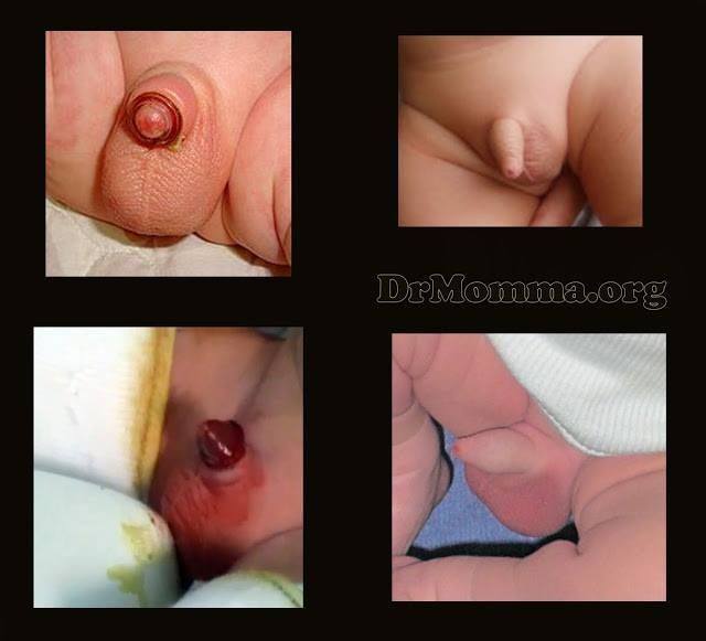 dkingpower7's tweet photo. #knifefree #clampfree #stringfree #i2 #genitalmutilation #circumcision #moms #dads #boys #momtobe https://t.co/RsCVAqvUZc