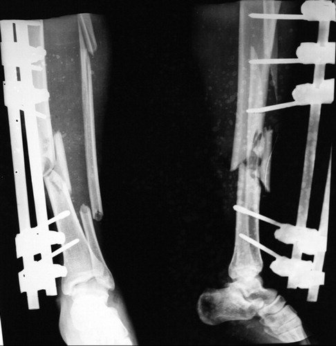BoneJointJ's tweet photo. Both ring and rail #fixators achieve comparable, #reliable rates of #union and functional #outcome in infected gap nonunions of the #tibia and help in treating #infection, shortening, #bone and loss of soft #tissue simultaneously without flap coverage https://t.co/Umy3euC83Q https://t.co/OvnpZF84oe