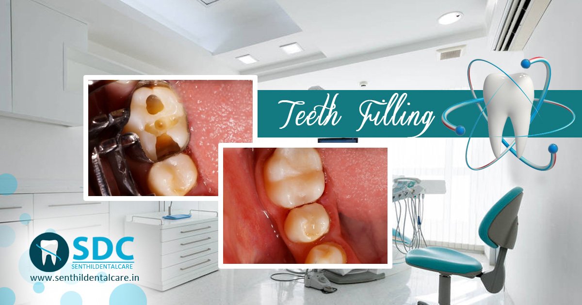 senthildental's tweet photo. @senthildental care offers wide variants of cosmetic #teethfillings to restore an abscessed tooth by the way of removing the decayed tooth material for cleaning the affected area and filling it with a cemented material.
Make Appointment: https://t.co/K8pdwwIx65 https://t.co/IzrXtuCuL7