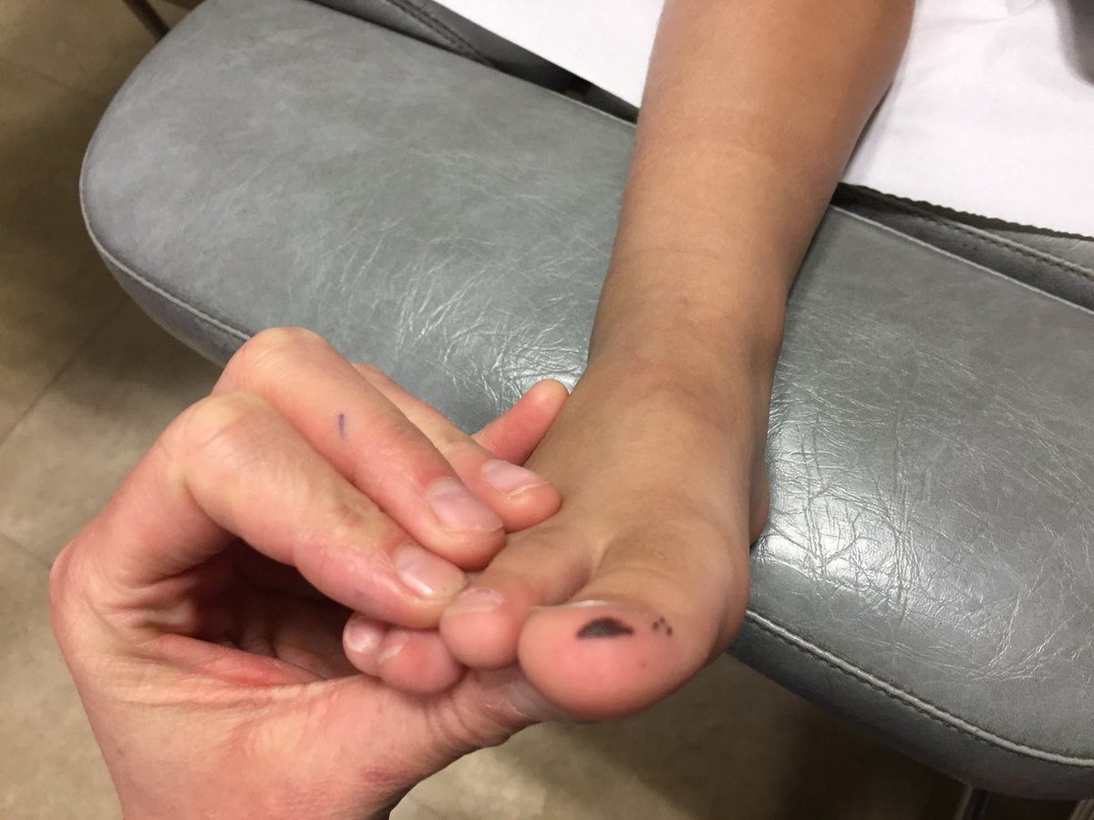 DocEtDoc's tweet photo. #docstoctoc #DocTocToc #dermatotoctoc enfant 3 ans et demi. Comme un pinçon couleur noire. « Tache » la plus grande présente à la naissance, s’est un peu agrandie, les autres apparues avant la marche. Besoin avis spécialiste? @phtiriasis merci! https://t.co/Kff68eRogC