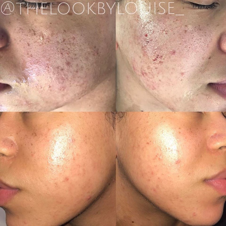 ivanmedgroup's tweet photo. Our UK exclusive @DermapenWorld has proven superior results against similar devices on the market. 

Just look at this amazing result on #problematicskin after just 1 #Dermapen treatment by @louisecunliffe3

For more information
0333 358 3904 
info@naturastudios.co.uk https://t.co/cBAPek2XHg
