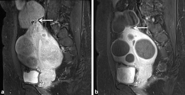 Uterine Artery Embolization for Pedunculated Subserosal Leiomyomas: Evidence of Safety and Efficacy | ow.ly/oTaO30jjVEP