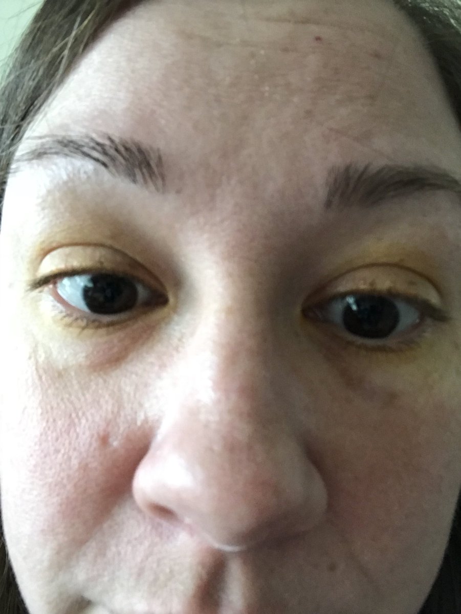 It been 3 weeks since I was admitted to hospital with a cerebral sinus venous thrombosis! Got my eyes checked out today, something good, no lasting damage internally but I look like a baddie from dr strange from the yellow dye! #recovery #venoussinusthrombosis