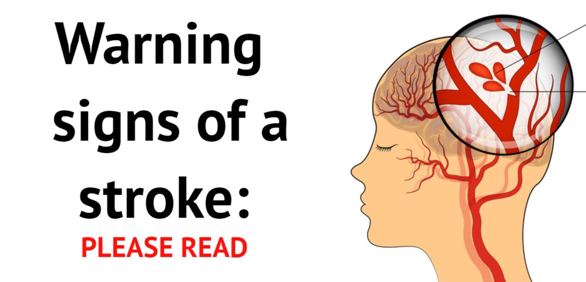 JudgeHickerson's tweet photo. Strokes can happen to anyone, anywhere, at any time. Preparedness is key! Please take a couple of minutes to read this info about the warning signs of a stroke and share it when you're done. https://t.co/TUKaYqwpt2 https://t.co/KzWEyO9Vrg