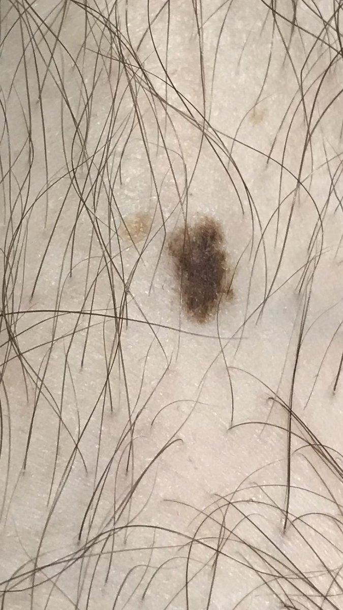 Êtes-vous inquiet pour votre patient ?
Que lui dites-vous? 
dermatoclic.com/melanome
#dermatoclic #DocTocToc