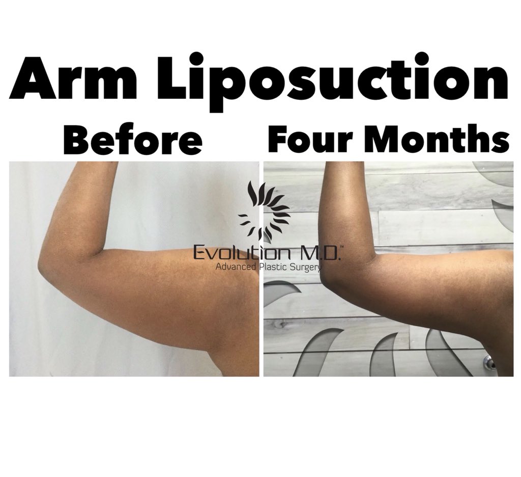 Evolution MD on X: Accumulated fat under the arms can make them