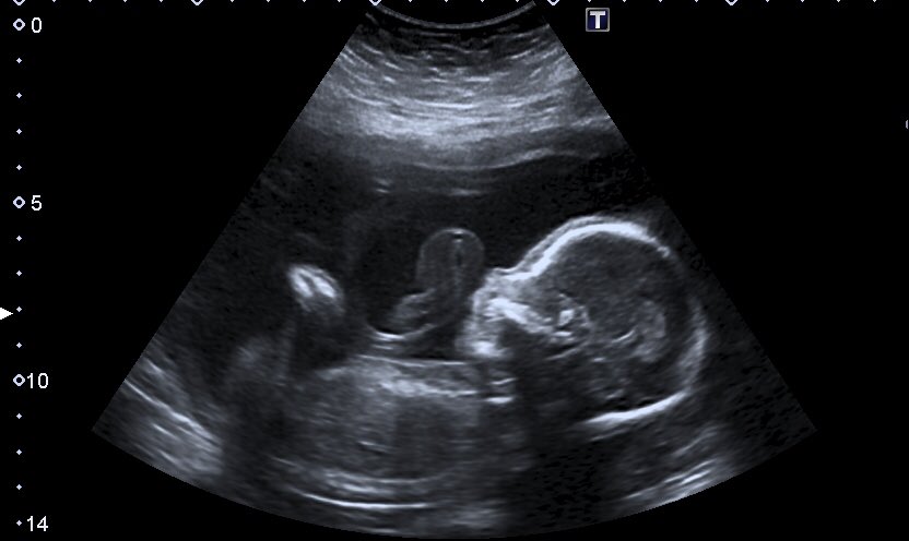 IVFBabyOnBoard's tweet image. 20 weeks cooked! Clever baby turned at just the right time so we get to go back&amp;amp;see Baby Carb Marks again in the next week or two to check some more measurements. YAY! 🎉😍 looking ok today though! We love you Baby Carb! ❤️
#IVFBabyOnBoard #20weekspregnant #20weekscan #soinlove