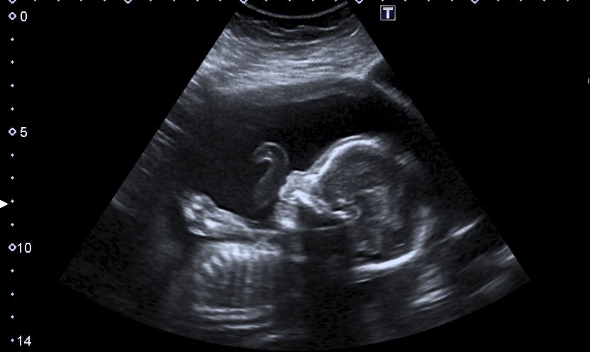 IVFBabyOnBoard's tweet image. 20 weeks cooked! Clever baby turned at just the right time so we get to go back&amp;amp;see Baby Carb Marks again in the next week or two to check some more measurements. YAY! 🎉😍 looking ok today though! We love you Baby Carb! ❤️
#IVFBabyOnBoard #20weekspregnant #20weekscan #soinlove