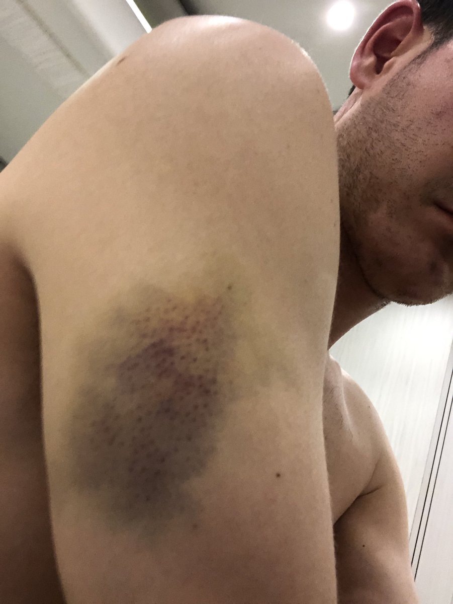 KyleLarsonRacin's tweet image. Thankfully this is all I got from my blown RF at Texas. 👍🏼