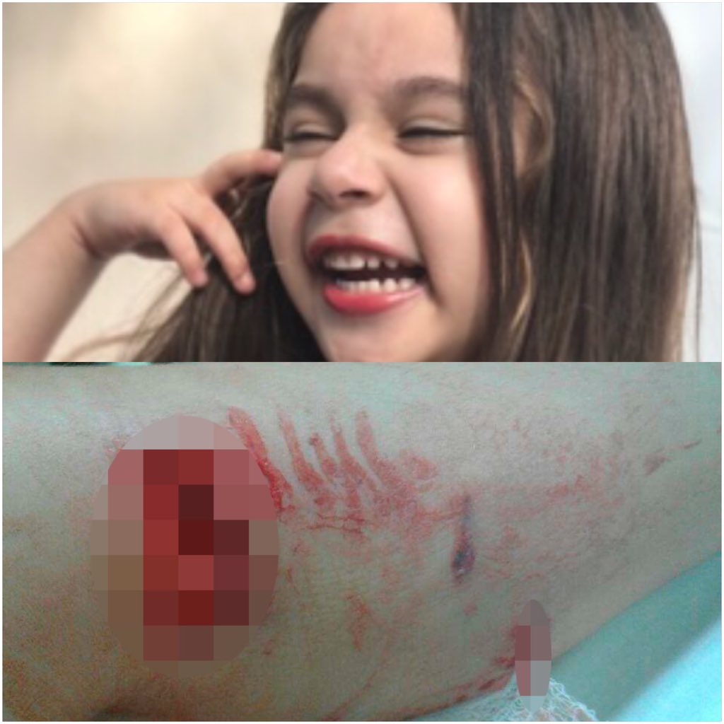 5-year-old girl attacked after dog breaks through fence, family says bit.ly/2vb0Pif https://t.co/y2RhF8IXYK