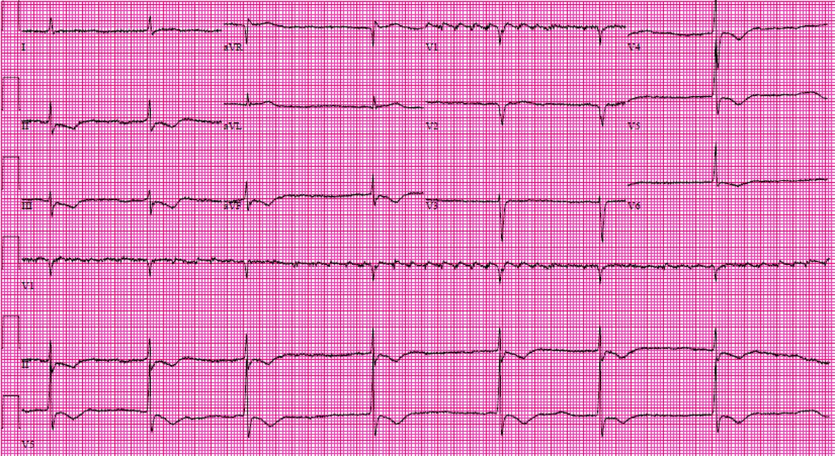 Course afib with bradycardia or PAT with block. Either way, think Dig toxicity, especially when you can see the digitalis effect (downsloaping, slurred ST depressions with inverted or biphasic T-waves). @OSUEMEdu