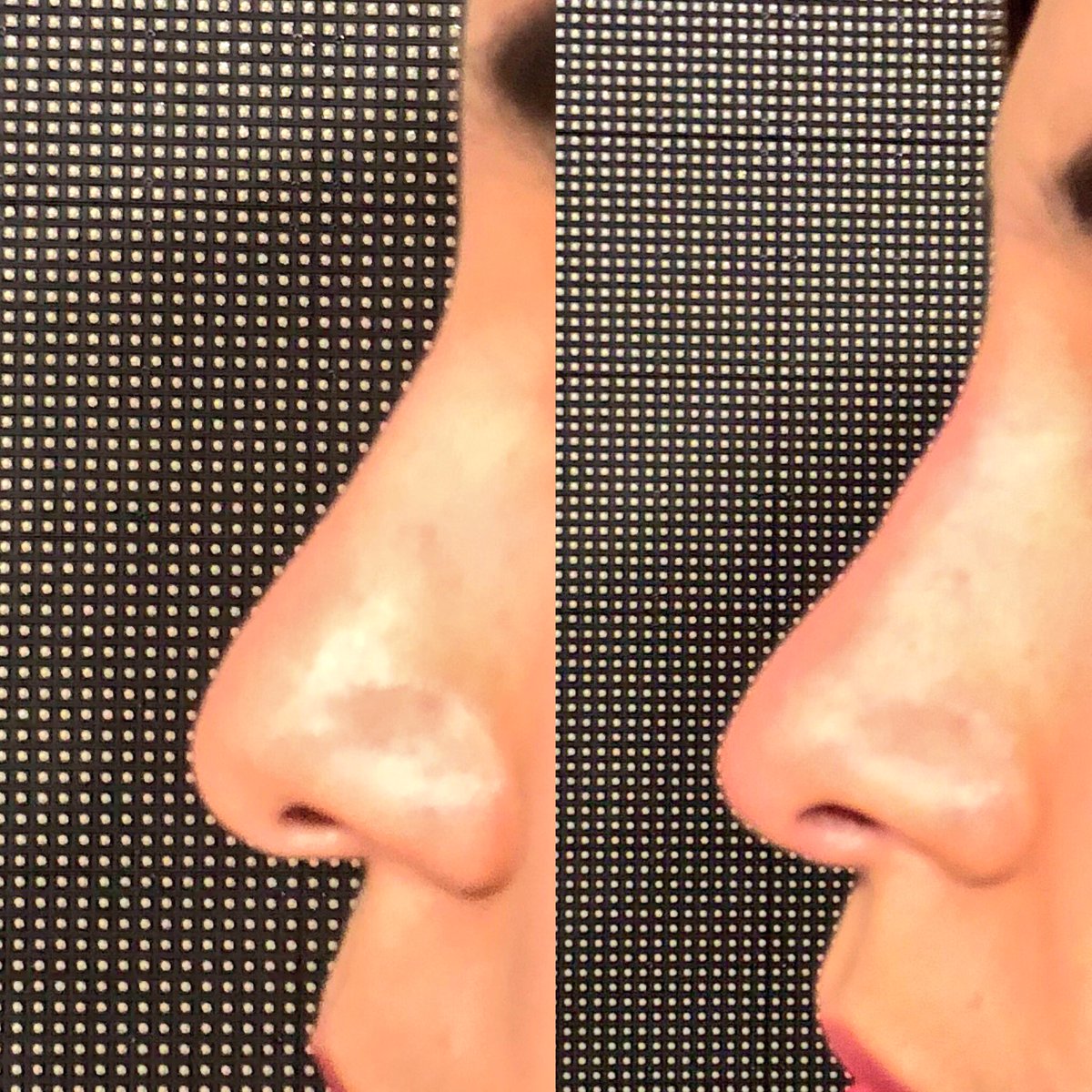 javierderma's tweet photo. Resultado de nuestra paciente de hoy en @ClubDeEva tratamiento #sincirugia aplicación de #achialuronico
Importante acudir con #dermatologos y #cirujanosplasticos certificados
Gracias por la invitación https://t.co/GBhIBKAmLK
