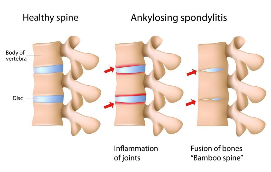 Clinpharmacy's tweet photo. Ankylosing Spondylitis: A Multi-Factorial Autoimmune Disease.MHC Class I, Antigen :Ankylosing spondylitis is a chronic systemic inflammatory disorder that primarily involves the sacroiliac joints and axial skeleton@#Journal of Hospital and Clinical Pharmacy https://t.co/KFAwYV1eRr