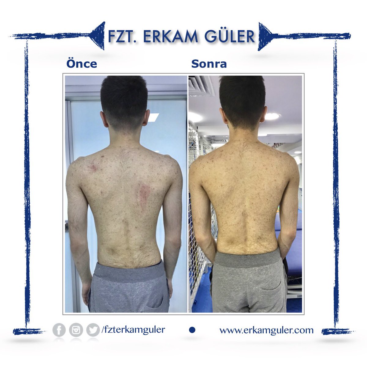 fzterkamguler's tweet image. 19 yaşında Skolyoz şikayetiyle başvuran hastamızın 16 seans Schroth 3D Skolyoz Egzersizleri sonrası son durumu. 👍👏

#schroththerapy #schrothmethod #scoliosis
#skolyoz #skolyoztedavisi
